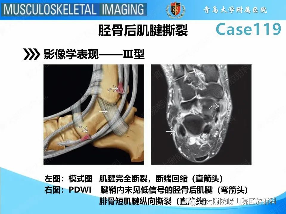 影像PPT - 【PPT】胫骨后肌腱撕裂-17