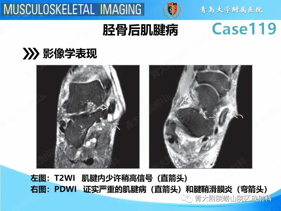 影像PPT - 【PPT】胫骨后肌腱撕裂-20
