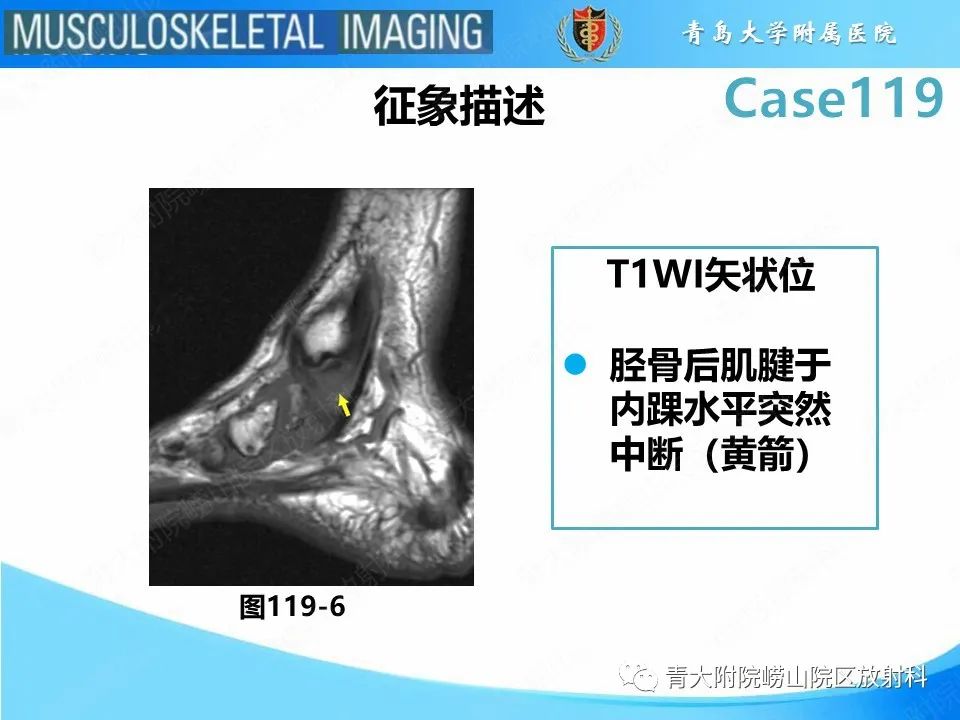 影像PPT - 【PPT】胫骨后肌腱撕裂-26