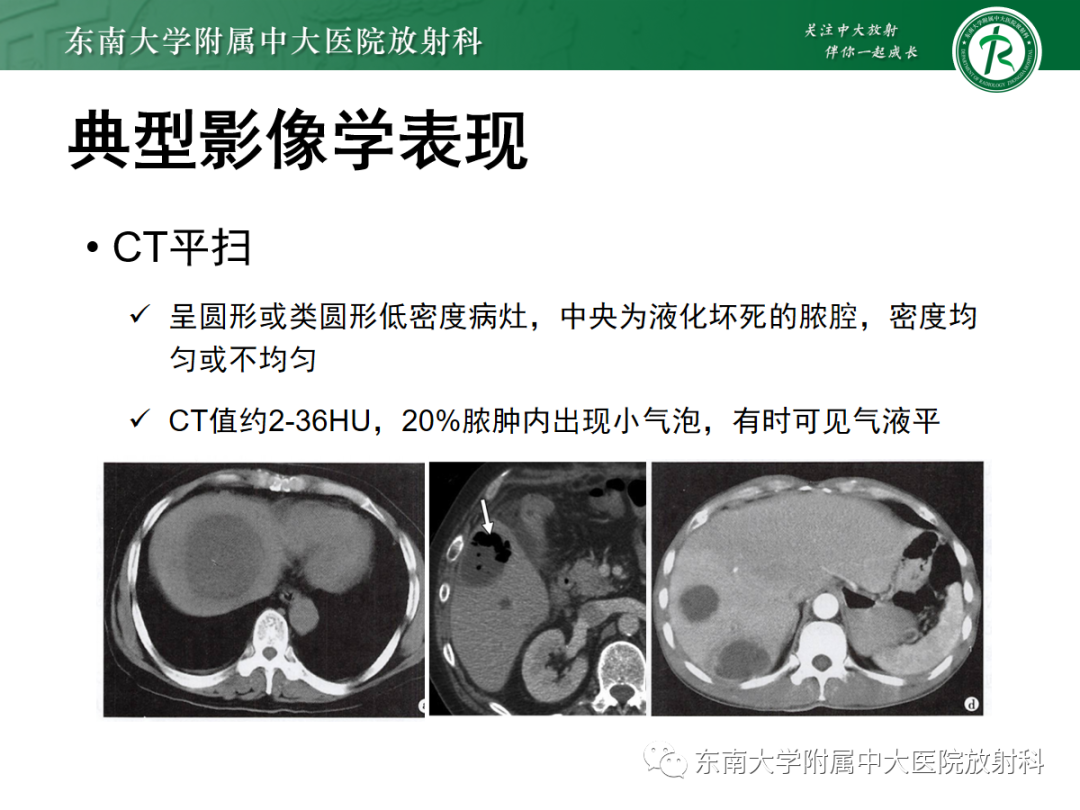 影像PPT - 【PPT】细菌性肝脓肿-9