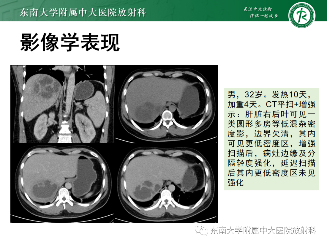 影像PPT - 【PPT】细菌性肝脓肿-12