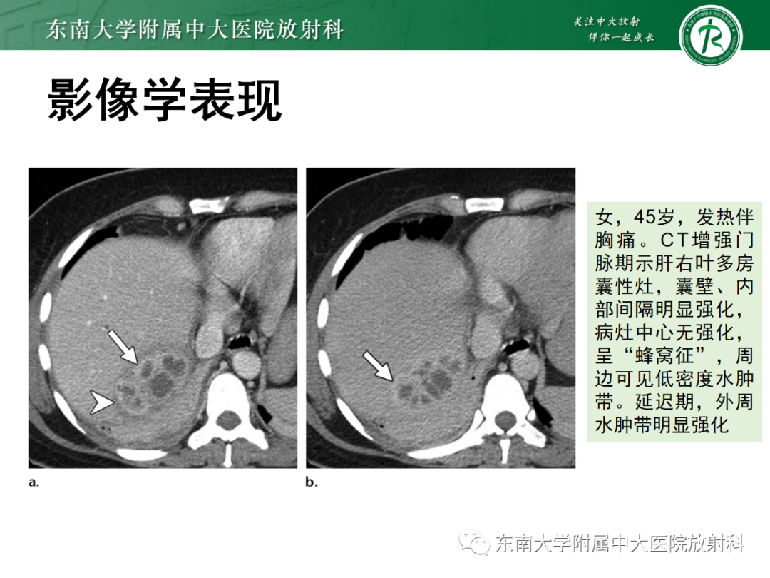 影像PPT - 【PPT】细菌性肝脓肿-13