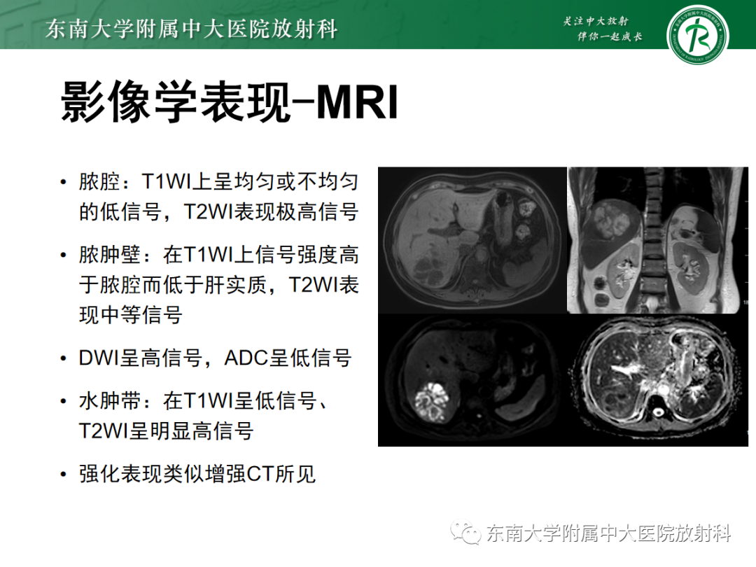 影像PPT - 【PPT】细菌性肝脓肿-14