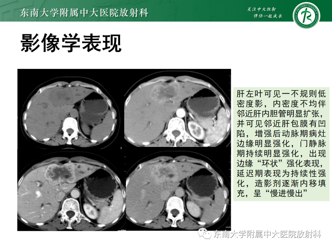 影像PPT - 【PPT】细菌性肝脓肿-18