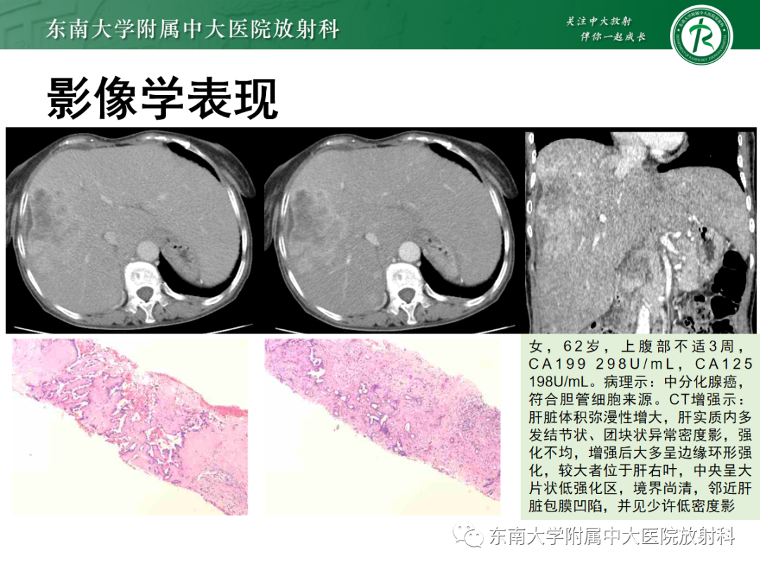 影像PPT - 【PPT】细菌性肝脓肿-19