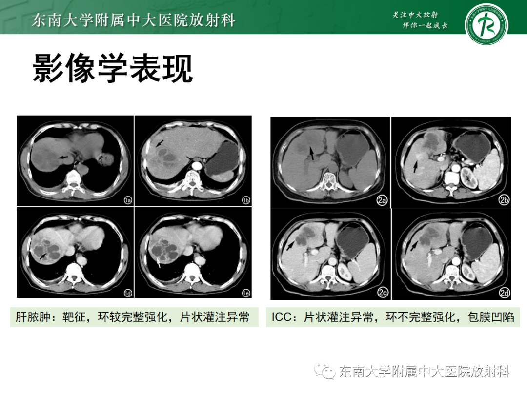 影像PPT - 【PPT】细菌性肝脓肿-22