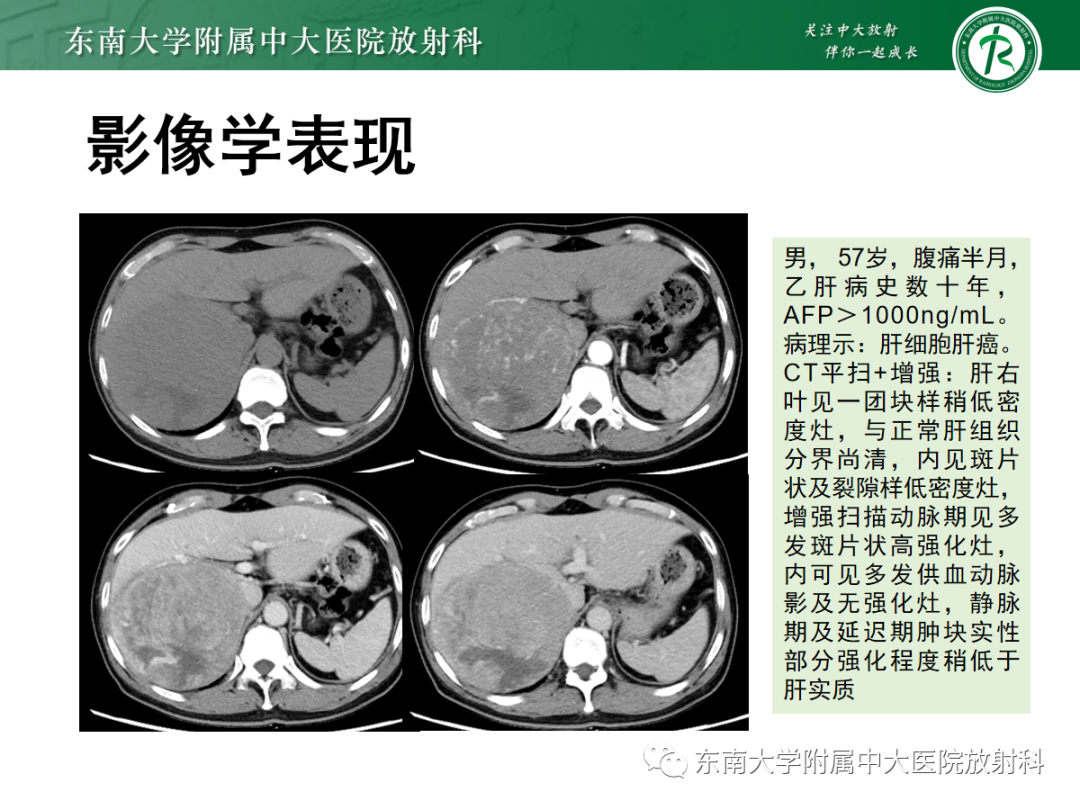 影像PPT - 【PPT】细菌性肝脓肿-25