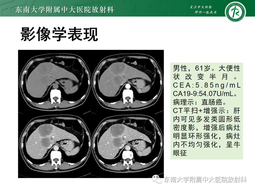 影像PPT - 【PPT】细菌性肝脓肿-27