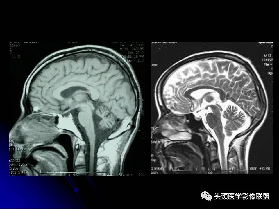 影像PPT - 【PPT】脑干区常见病变影像表现-9