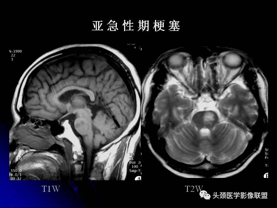 影像PPT - 【PPT】脑干区常见病变影像表现-13
