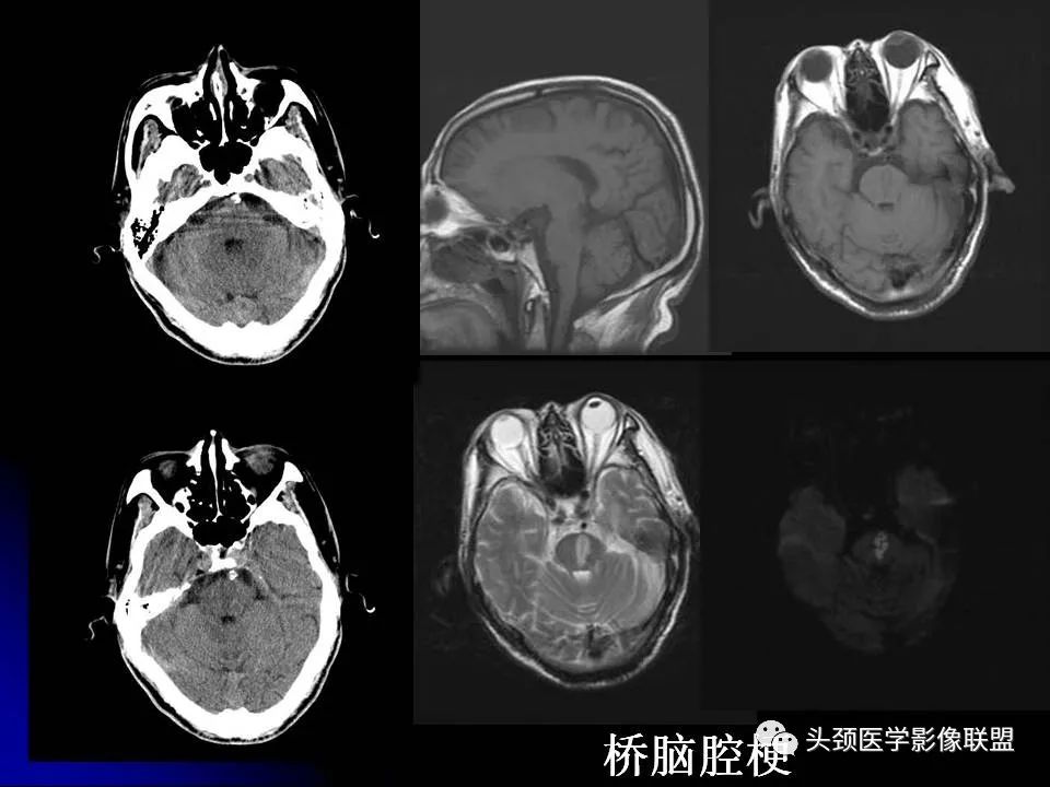 影像PPT - 【PPT】脑干区常见病变影像表现-15