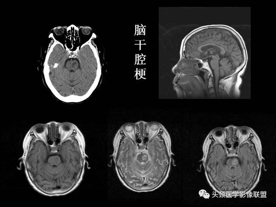 影像PPT - 【PPT】脑干区常见病变影像表现-14
