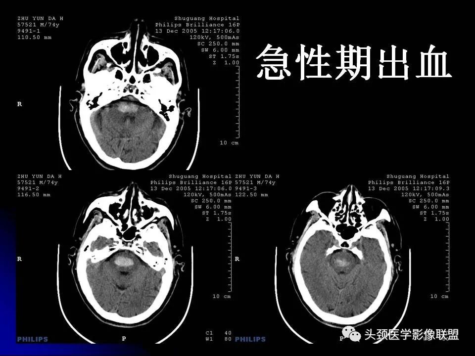 影像PPT - 【PPT】脑干区常见病变影像表现-18