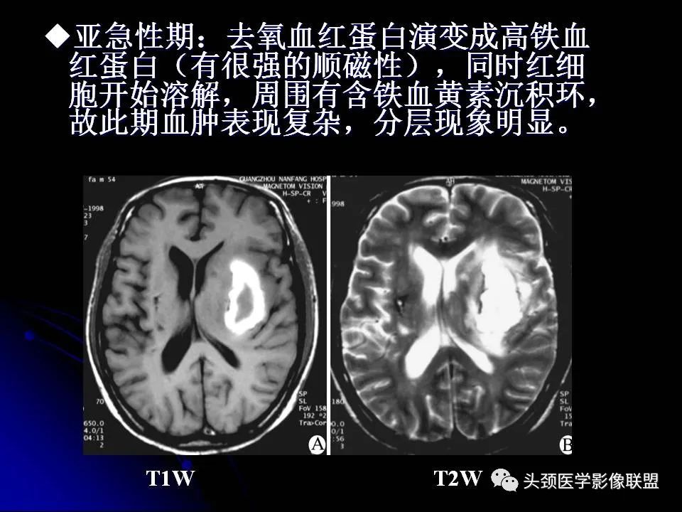 影像PPT - 【PPT】脑干区常见病变影像表现-20