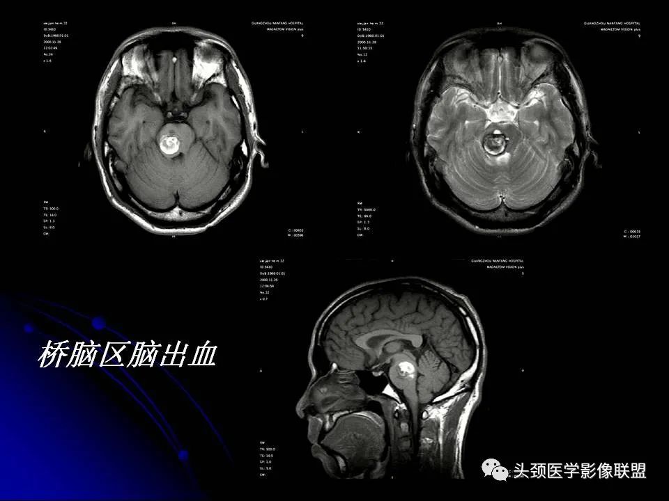 影像PPT - 【PPT】脑干区常见病变影像表现-22