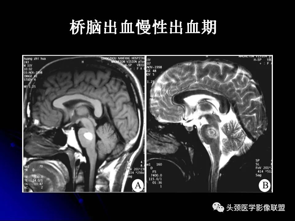 影像PPT - 【PPT】脑干区常见病变影像表现-23