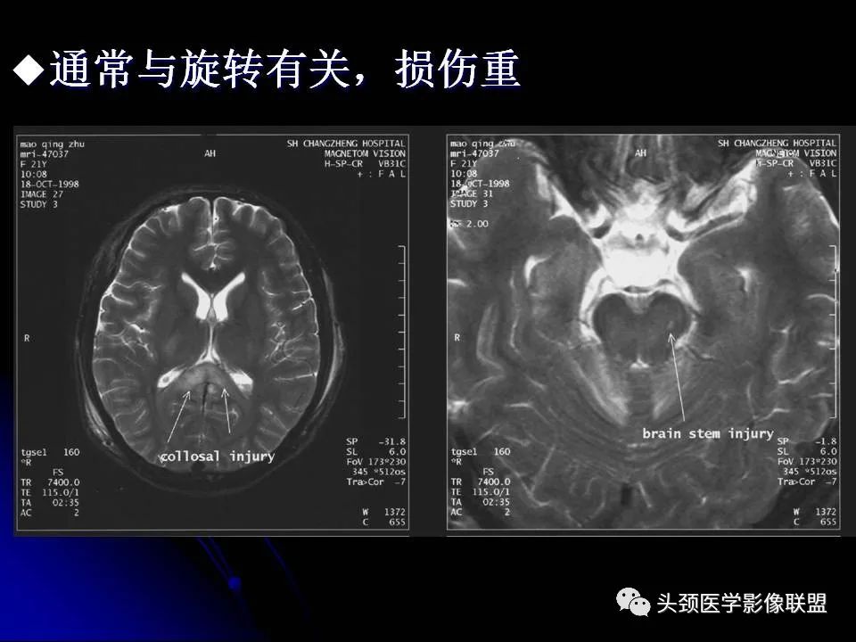 影像PPT - 【PPT】脑干区常见病变影像表现-26