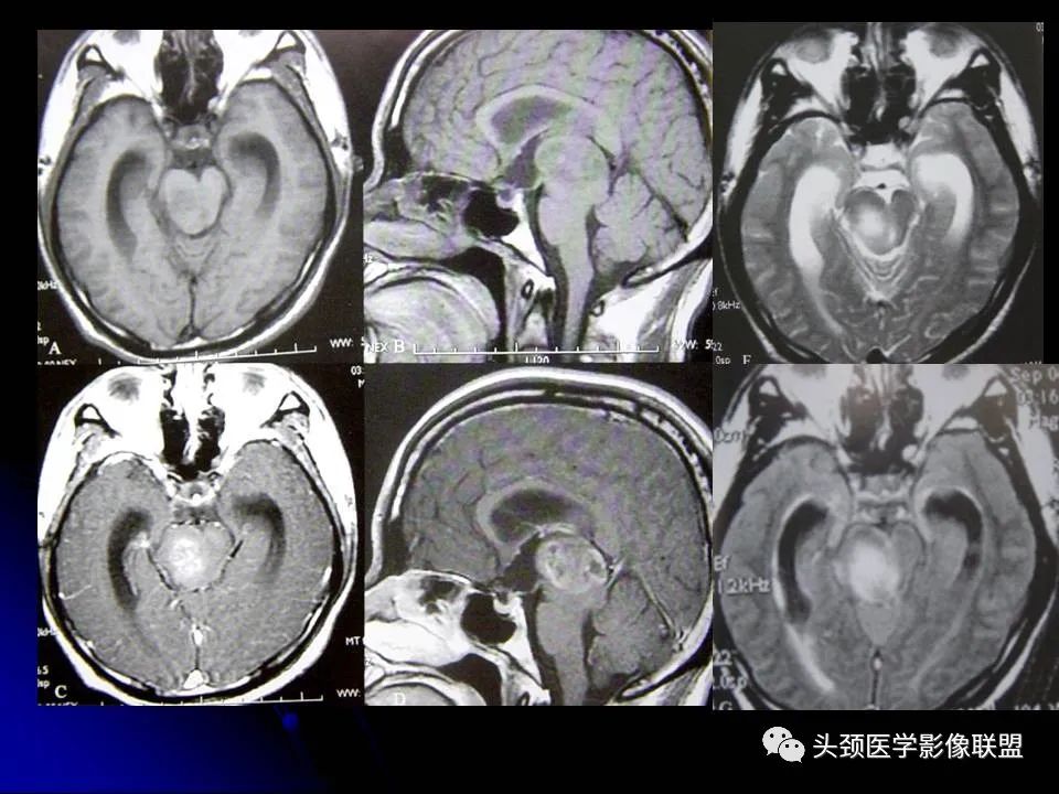 影像PPT - 【PPT】脑干区常见病变影像表现-31