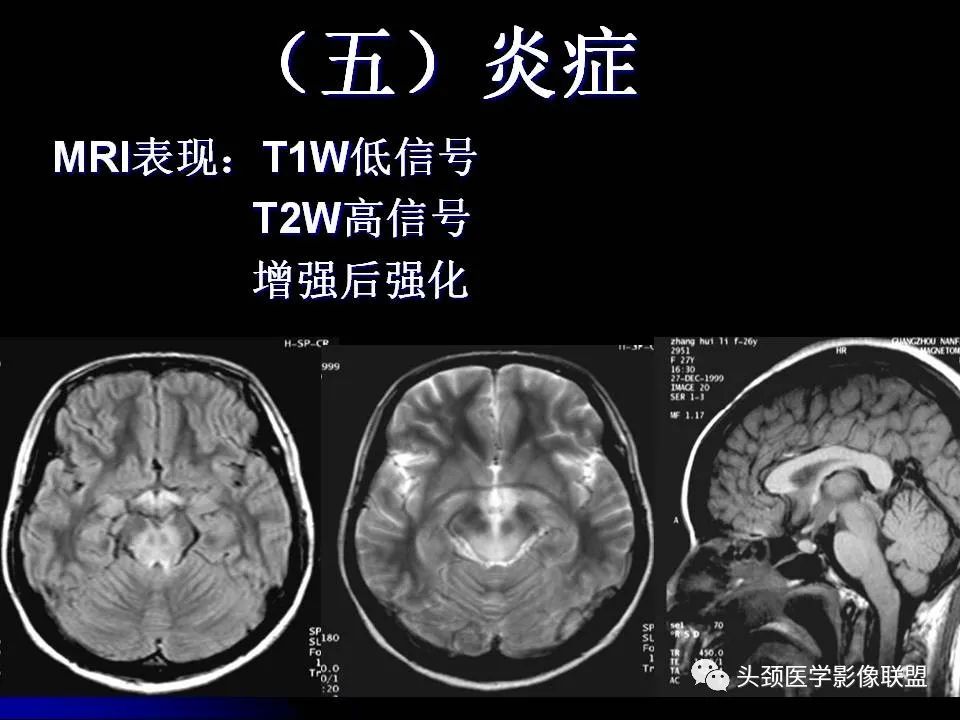 影像PPT - 【PPT】脑干区常见病变影像表现-34