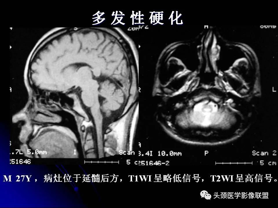 影像PPT - 【PPT】脑干区常见病变影像表现-36