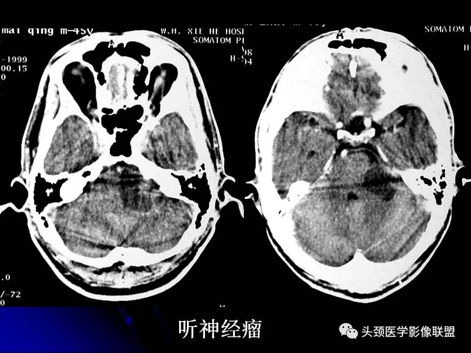 影像PPT - 【PPT】脑干区常见病变影像表现-38