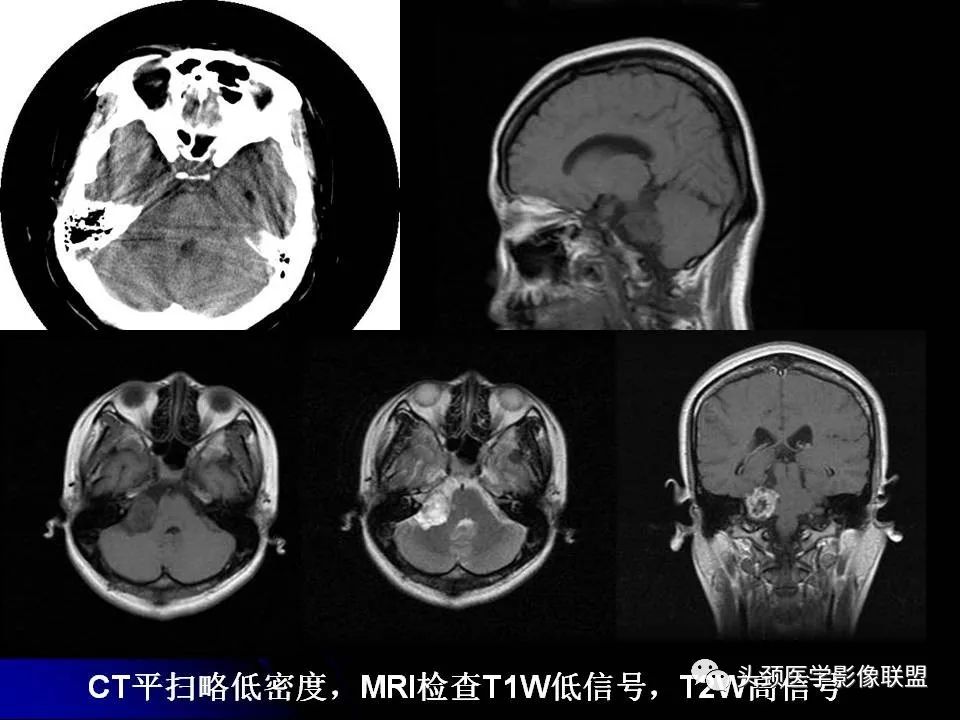 影像PPT - 【PPT】脑干区常见病变影像表现-39
