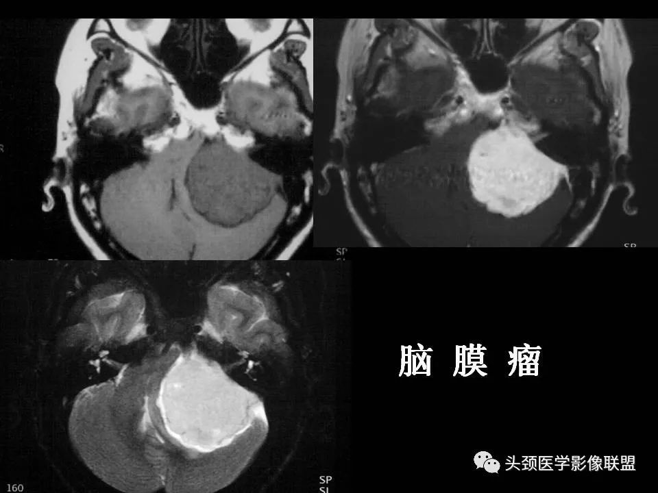 影像PPT - 【PPT】脑干区常见病变影像表现-40