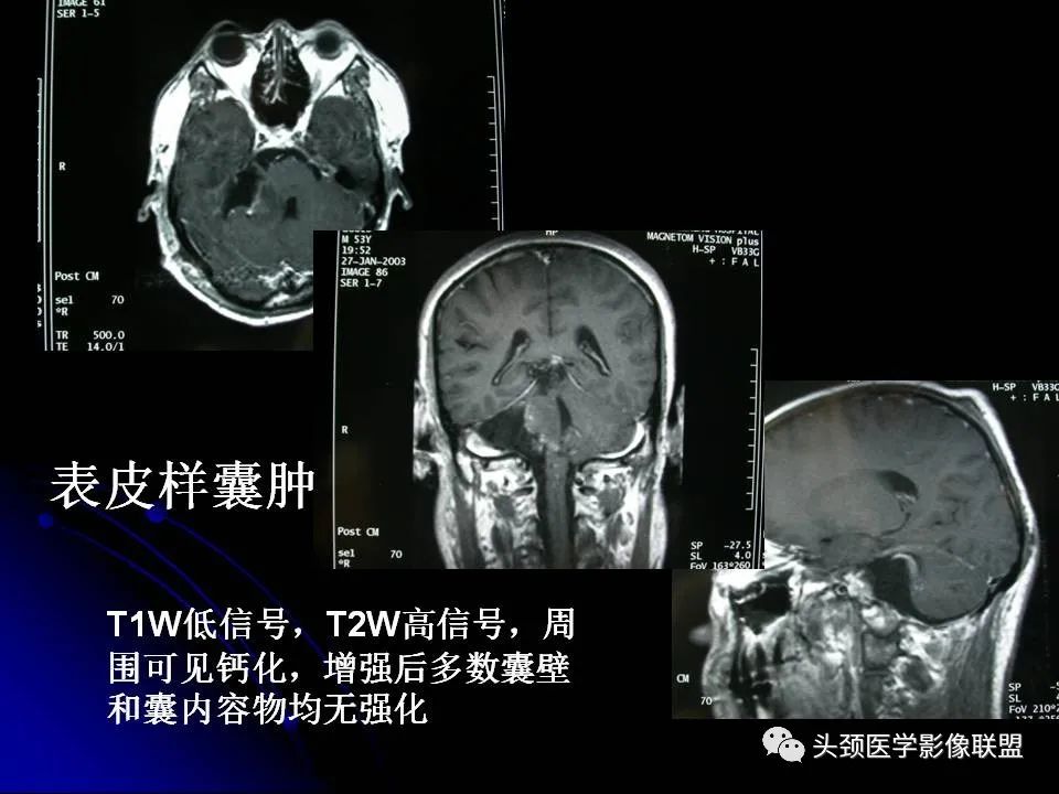 影像PPT - 【PPT】脑干区常见病变影像表现-41