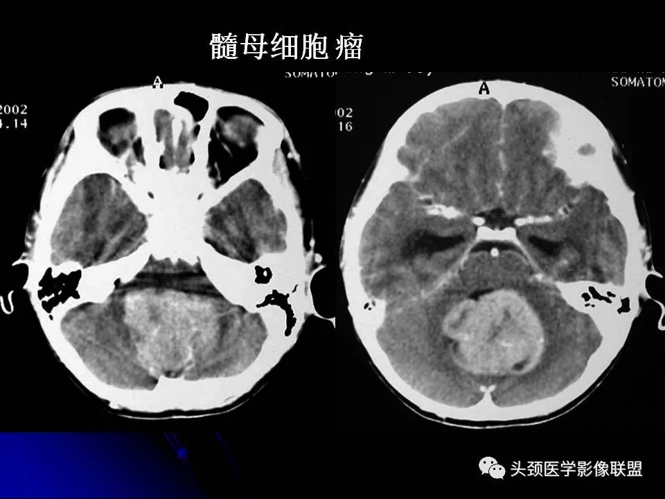 影像PPT - 【PPT】脑干区常见病变影像表现-42