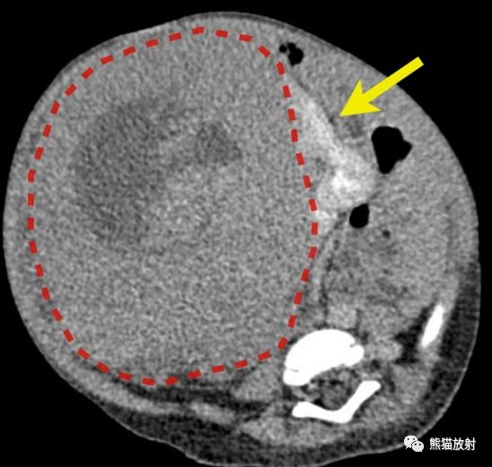 影像PPT - 【病例】你知道什么是“爪征”吗—肾母细胞瘤-5 影像PPT - 【病例】你知道什么是“爪征”吗—肾母细胞瘤-5