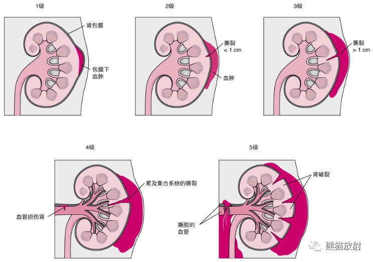 影像PPT - 腹部外伤(肝/脾/肾)损伤分级、CT表现-28 影像PPT - 腹部外伤(肝/脾/肾)损伤分级、CT表现-28
