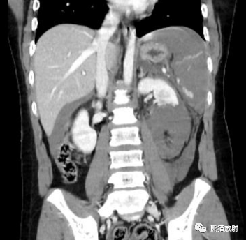 影像PPT - 腹部外伤(肝/脾/肾)损伤分级、CT表现-34 影像PPT - 腹部外伤(肝/脾/肾)损伤分级、CT表现-34