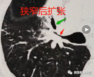 影像PPT - 【病例】从支气管影像改变区分肿瘤与结核-32 影像PPT - 【病例】从支气管影像改变区分肿瘤与结核-32