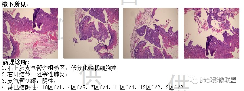 影像PPT - 【病例】从支气管影像改变区分肿瘤与结核-51 影像PPT - 【病例】从支气管影像改变区分肿瘤与结核-51