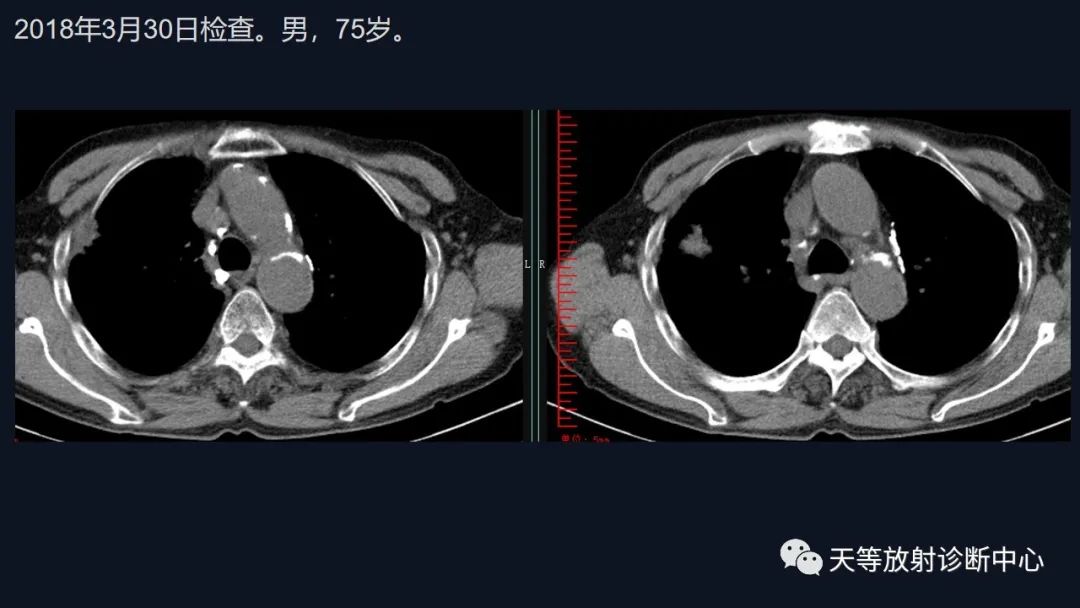 影像PPT - 【病例】肺结核1例CT影像-2 影像PPT - 【病例】肺结核1例CT影像-2