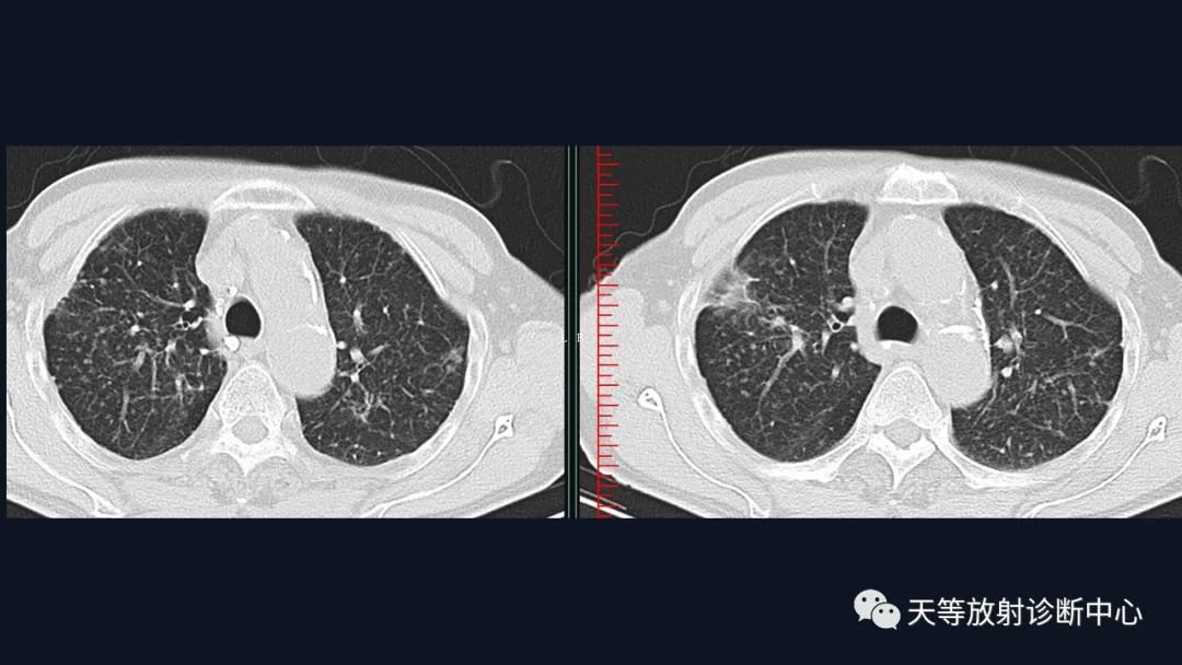 影像PPT - 【病例】肺结核1例CT影像-26 影像PPT - 【病例】肺结核1例CT影像-26