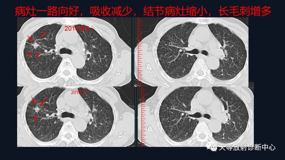 影像PPT - 【病例】肺结核1例CT影像-31 影像PPT - 【病例】肺结核1例CT影像-31