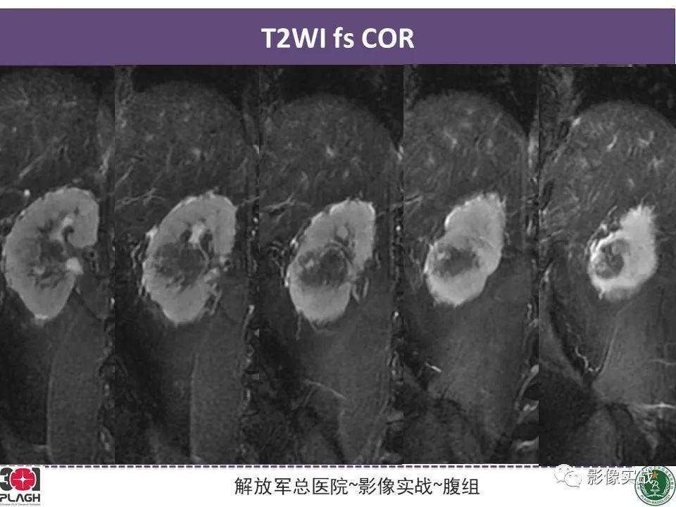 影像PPT - 【病例】右肾透明细胞肾癌1例MR影像-5