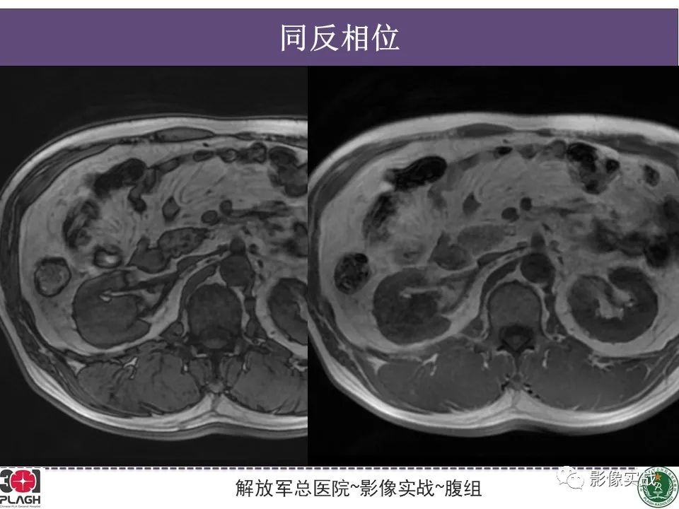 影像PPT - 【病例】右肾透明细胞肾癌1例MR影像-7