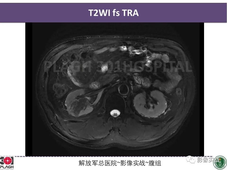 影像PPT - 【病例】右肾透明细胞肾癌1例MR影像-1
