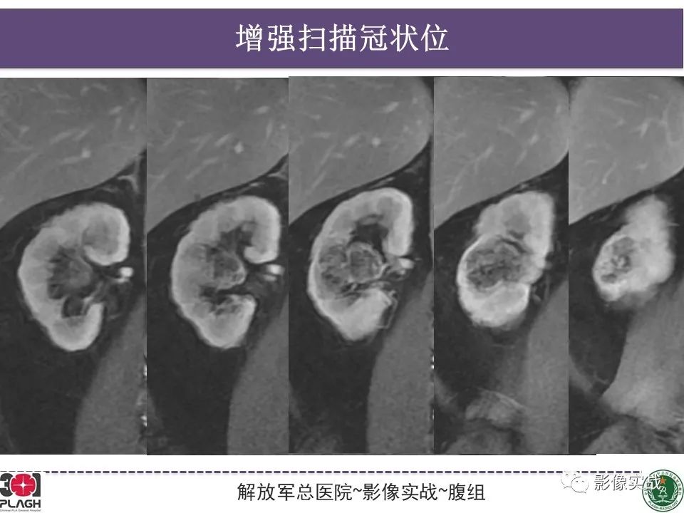影像PPT - 【病例】右肾透明细胞肾癌1例MR影像-2