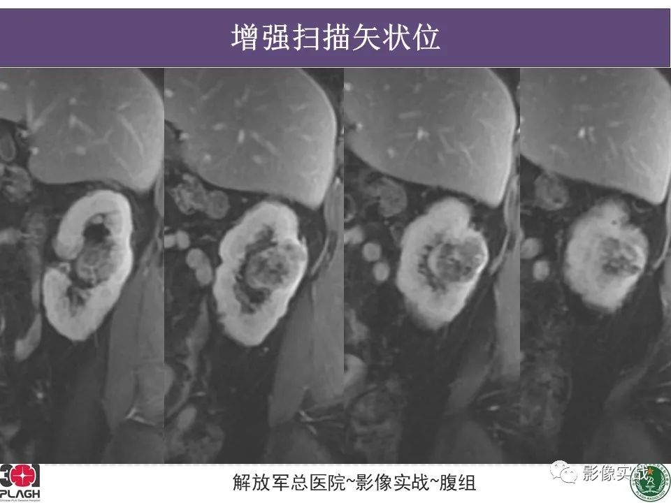 影像PPT - 【病例】右肾透明细胞肾癌1例MR影像-3