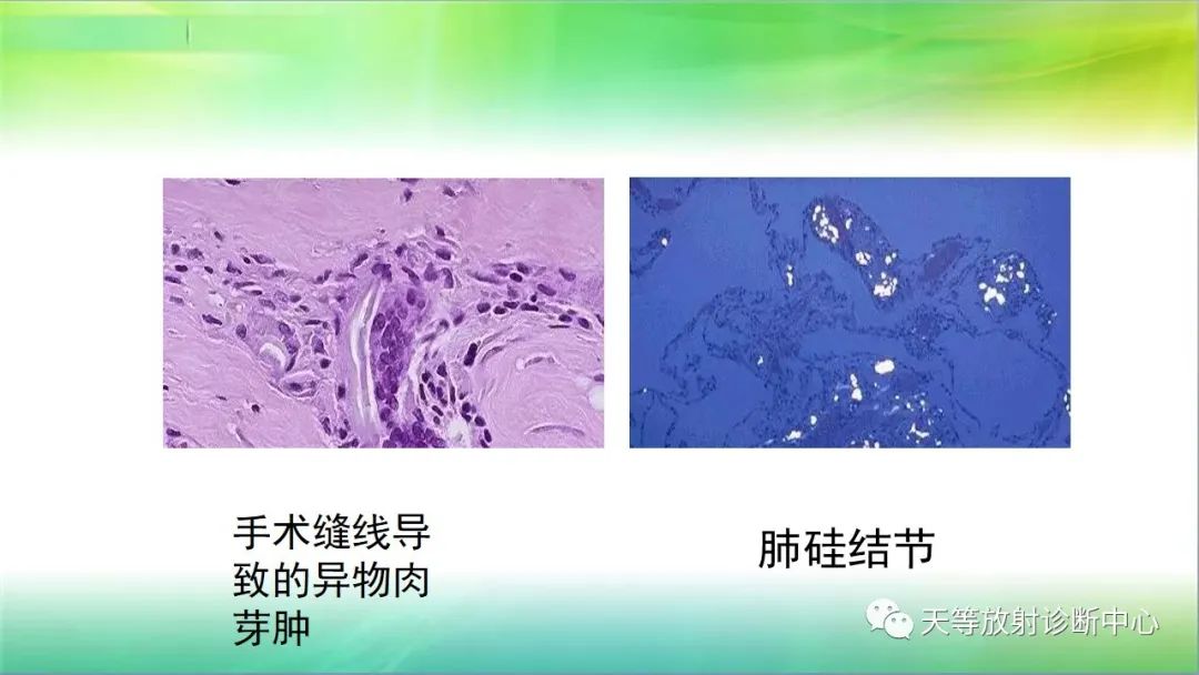 影像PPT - 【PPT】肺结核肉芽肿性影像学诊断与鉴别诊断-4 影像PPT - 【PPT】肺结核肉芽肿性影像学诊断与鉴别诊断-4