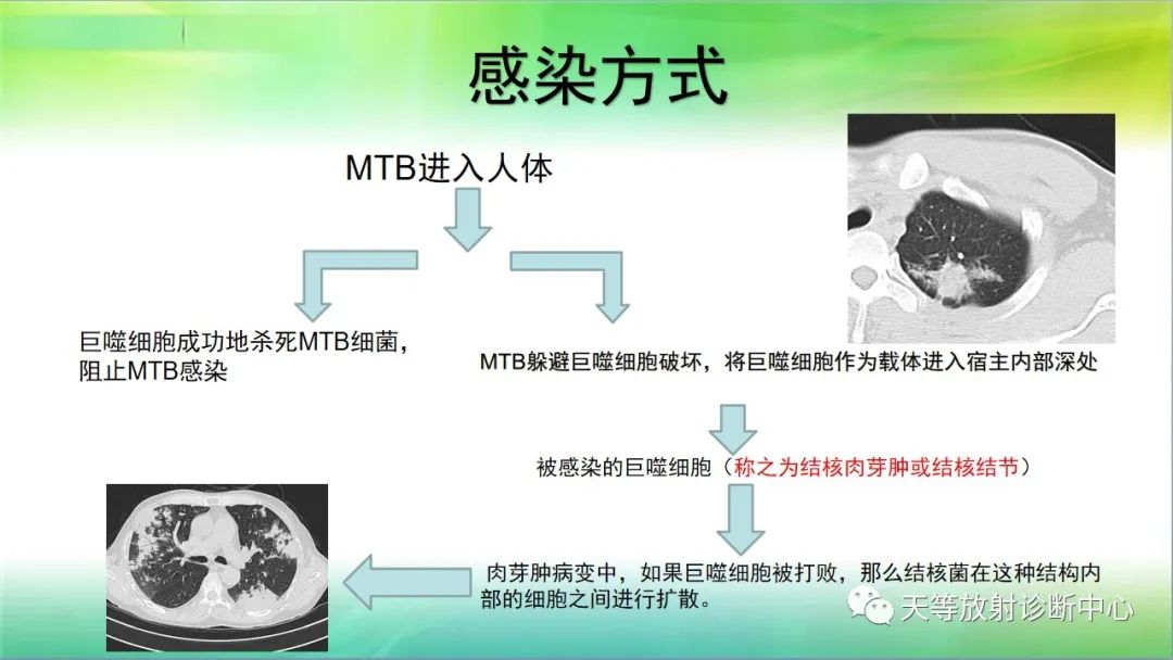 影像PPT - 【PPT】肺结核肉芽肿性影像学诊断与鉴别诊断-6 影像PPT - 【PPT】肺结核肉芽肿性影像学诊断与鉴别诊断-6