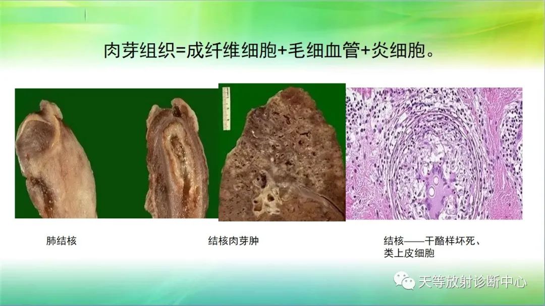 影像PPT - 【PPT】肺结核肉芽肿性影像学诊断与鉴别诊断-7 影像PPT - 【PPT】肺结核肉芽肿性影像学诊断与鉴别诊断-7