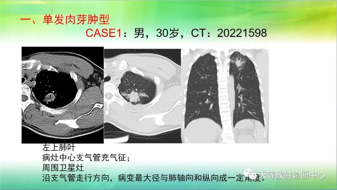 影像PPT - 【PPT】肺结核肉芽肿性影像学诊断与鉴别诊断-9 影像PPT - 【PPT】肺结核肉芽肿性影像学诊断与鉴别诊断-9