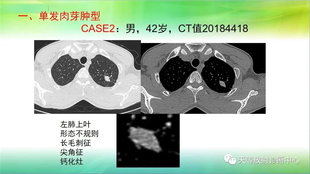 影像PPT - 【PPT】肺结核肉芽肿性影像学诊断与鉴别诊断-10 影像PPT - 【PPT】肺结核肉芽肿性影像学诊断与鉴别诊断-10