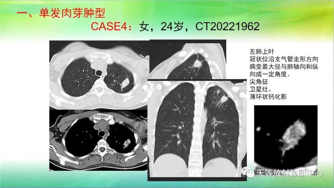 影像PPT - 【PPT】肺结核肉芽肿性影像学诊断与鉴别诊断-12 影像PPT - 【PPT】肺结核肉芽肿性影像学诊断与鉴别诊断-12
