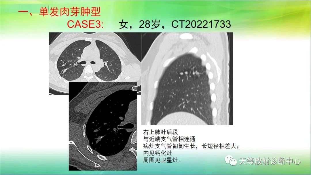 影像PPT - 【PPT】肺结核肉芽肿性影像学诊断与鉴别诊断-11 影像PPT - 【PPT】肺结核肉芽肿性影像学诊断与鉴别诊断-11