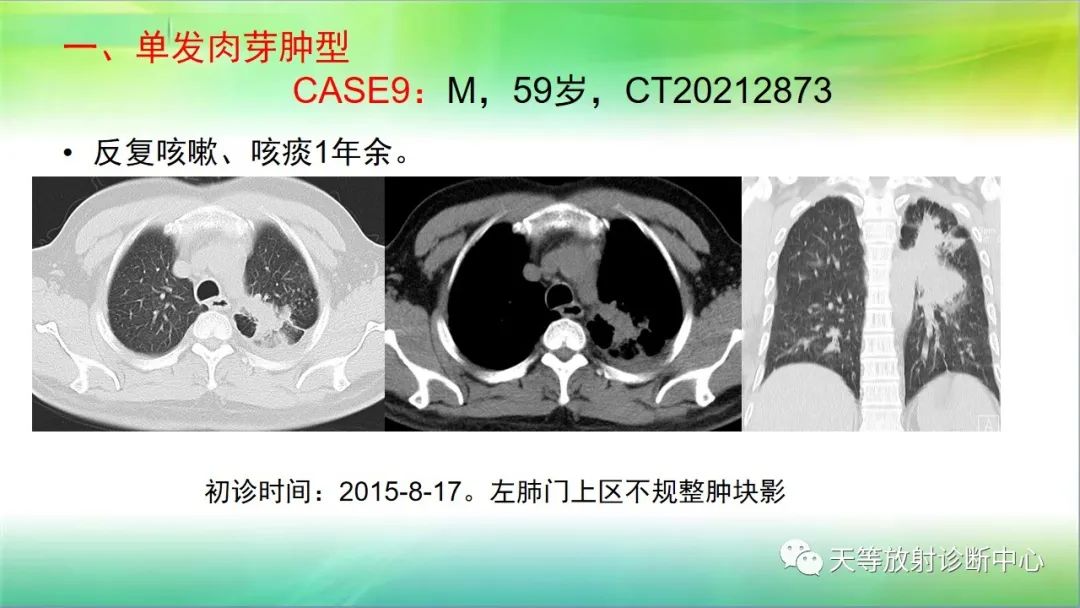 影像PPT - 【PPT】肺结核肉芽肿性影像学诊断与鉴别诊断-17 影像PPT - 【PPT】肺结核肉芽肿性影像学诊断与鉴别诊断-17